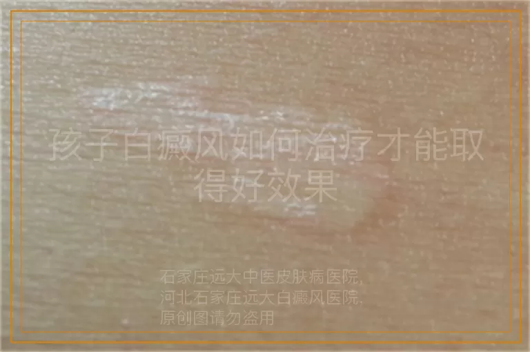 孩子白癜风如何治疗才能取得好效果