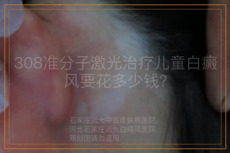 308准分子激光治疗儿童白癜风要花多少钱？