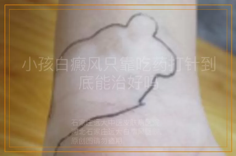小孩白癜风只靠吃药打针到底能治好吗