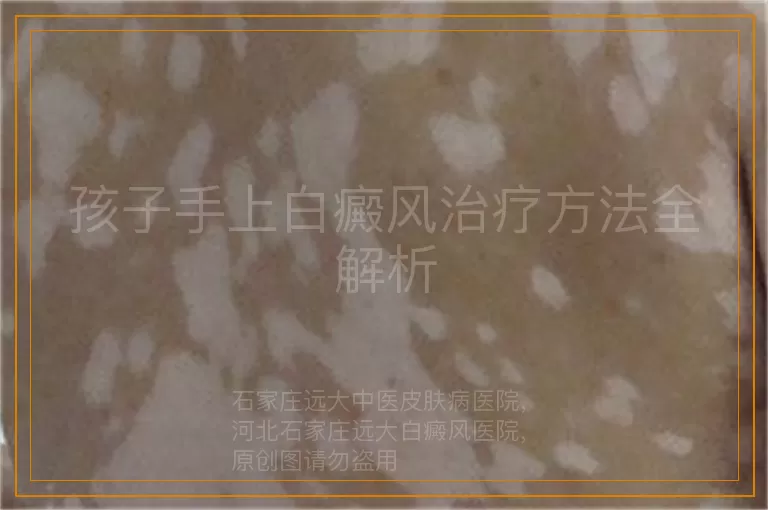 孩子手上白癜风治疗方法全解析