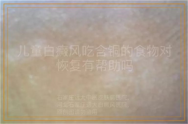 儿童白癜风吃含铜的食物对恢复有帮助吗