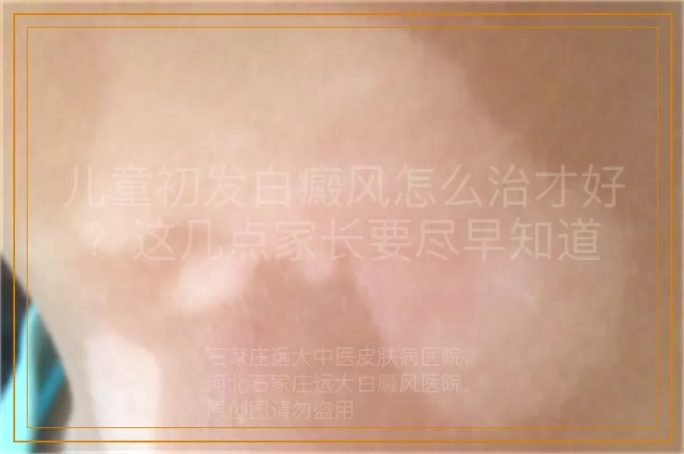 儿童初发白癜风怎么治才好？这几点家长要尽早知道