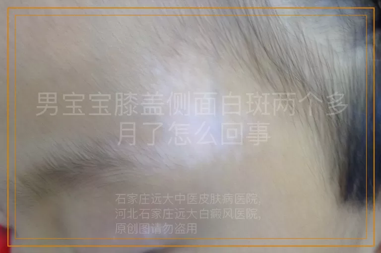 男宝宝膝盖侧面白斑两个多月了怎么回事