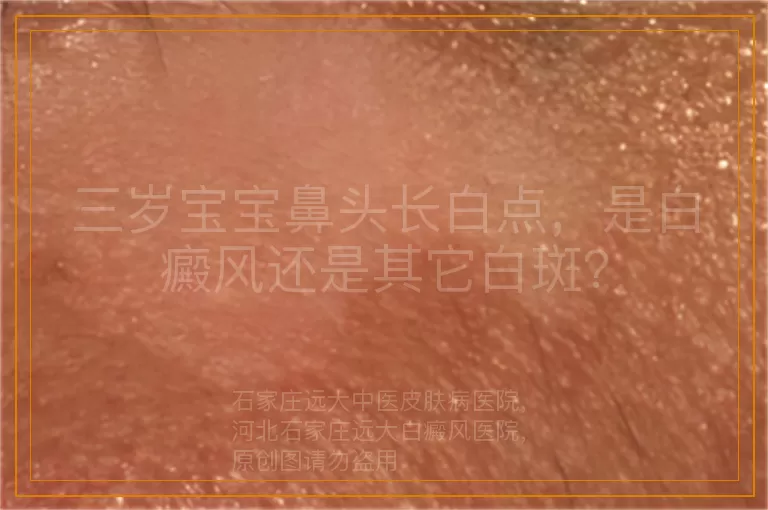 三岁宝宝鼻头长白点，是白癜风还是其它白斑？