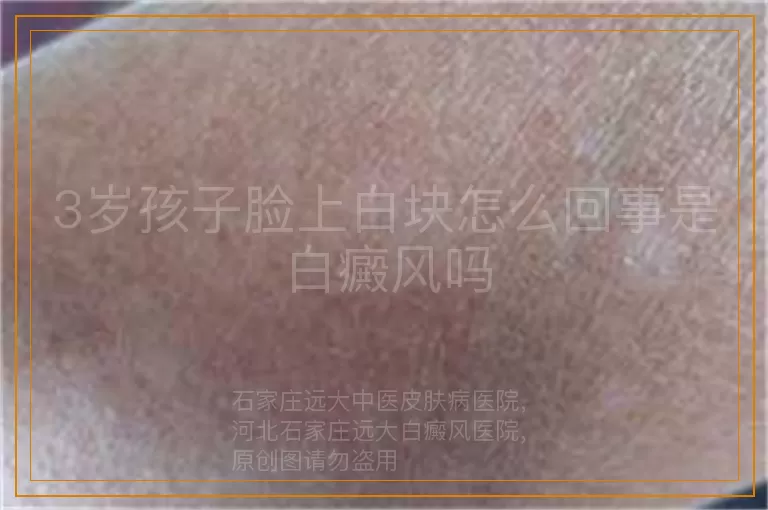 3岁孩子脸上白块怎么回事是白癜风吗