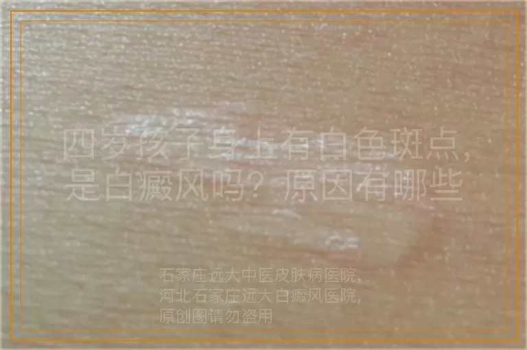 四岁孩子身上有白色斑点，是白癜风吗？原因有哪些