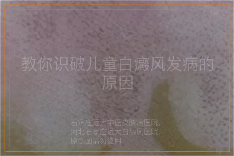 教你识破儿童白癜风发病的原因