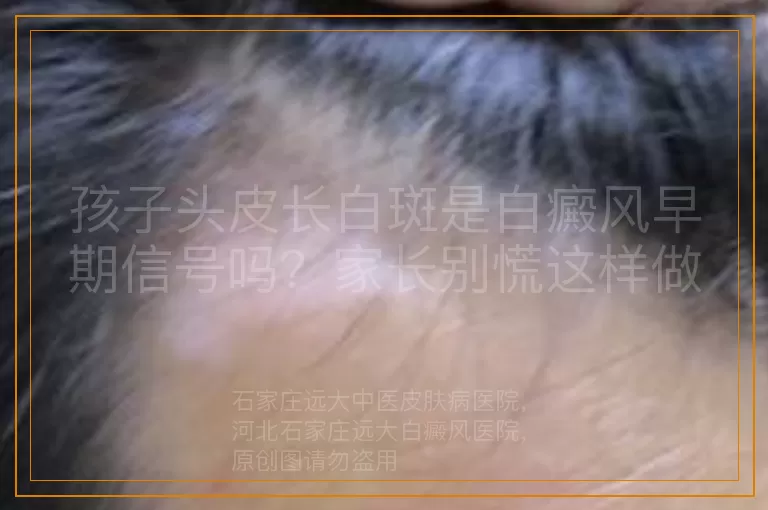 孩子头皮长白斑是白癜风早期信号吗？家长别慌这样做
