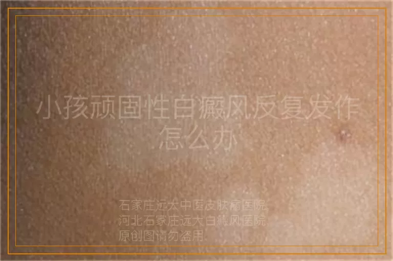 小孩顽固性白癜风反复发作怎么办