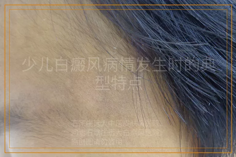 少儿白癜风病情发生时的典型特点