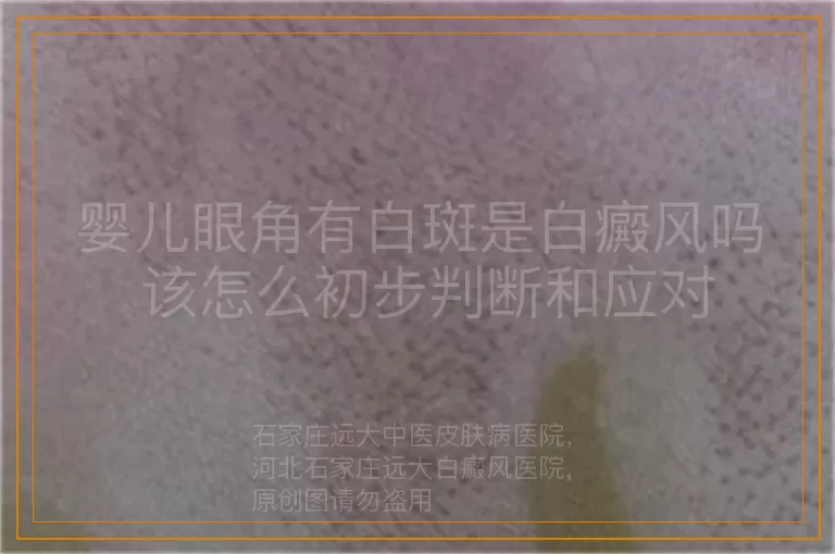 婴儿眼角有白斑是白癜风吗 该怎么初步判断和应对