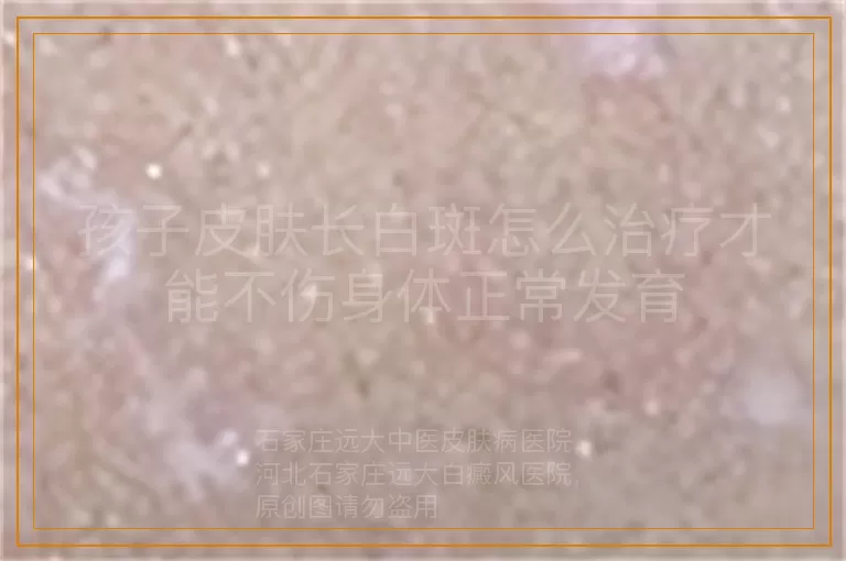 孩子皮肤长白斑怎么治疗才能不伤身体正常发育