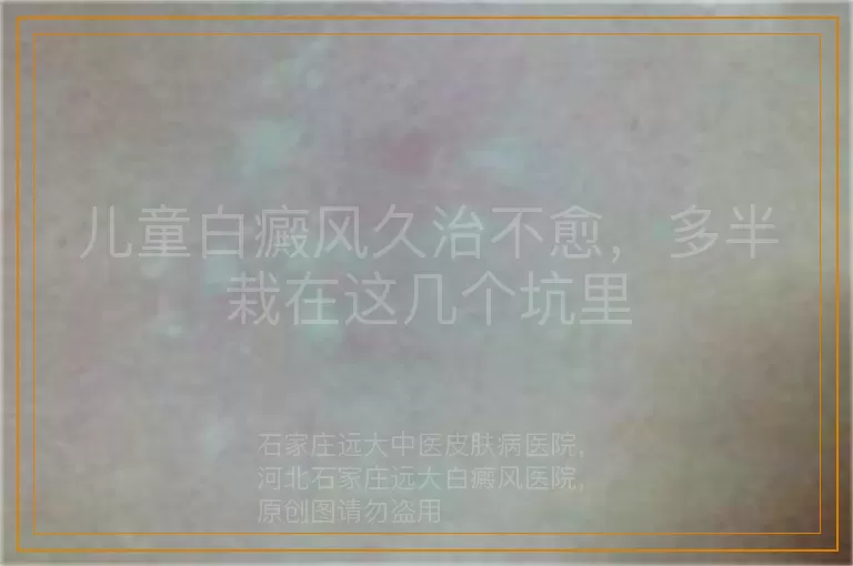 儿童白癜风久治不愈，多半栽在这几个坑里