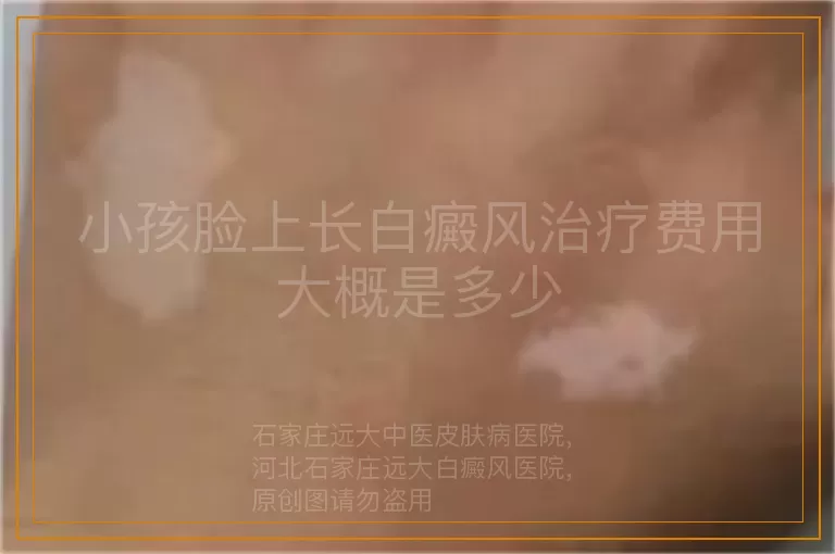 小孩脸上长白癜风治疗费用大概是多少