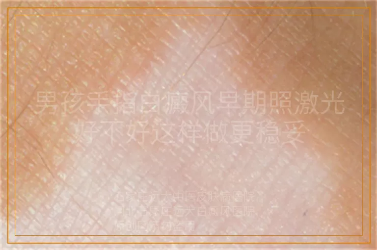 男孩手指白癜风早期照激光好不好这样做更稳妥