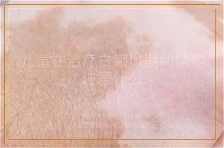 儿童在治疗白癜风期间需要注意什么