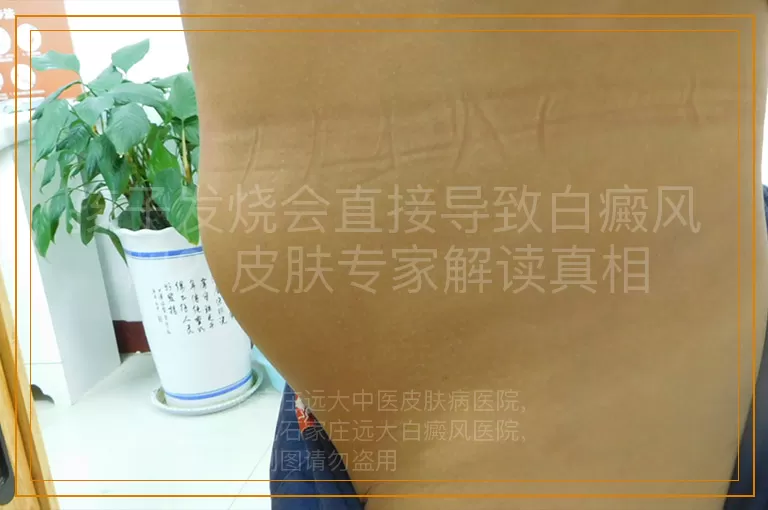 孩子发烧会直接导致白癜风吗？皮肤专家解读真相