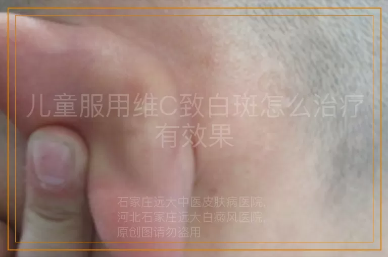 儿童服用维C致白斑怎么治疗有效果