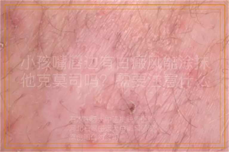 小孩嘴唇边有白癜风能涂抹他克莫司吗？需要注意什么