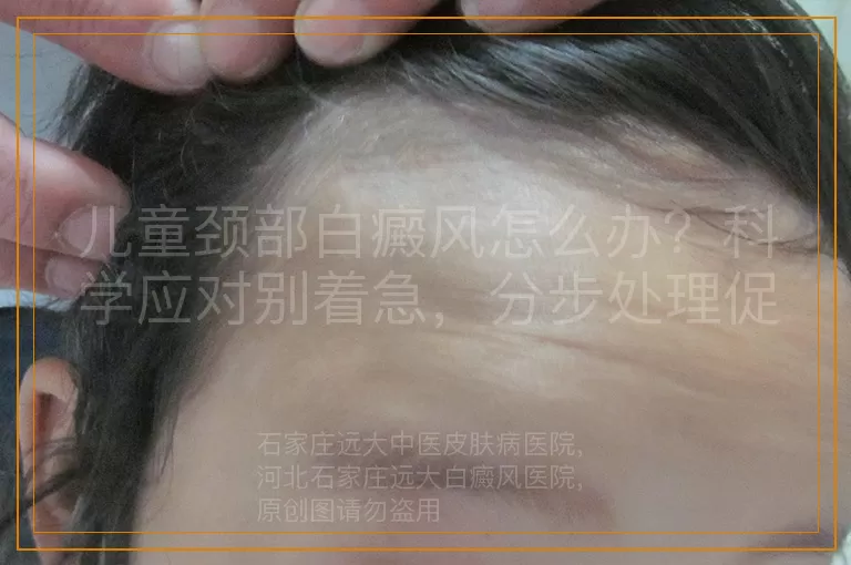 儿童颈部白癜风怎么办？科学应对别着急，分步处理促进恢复