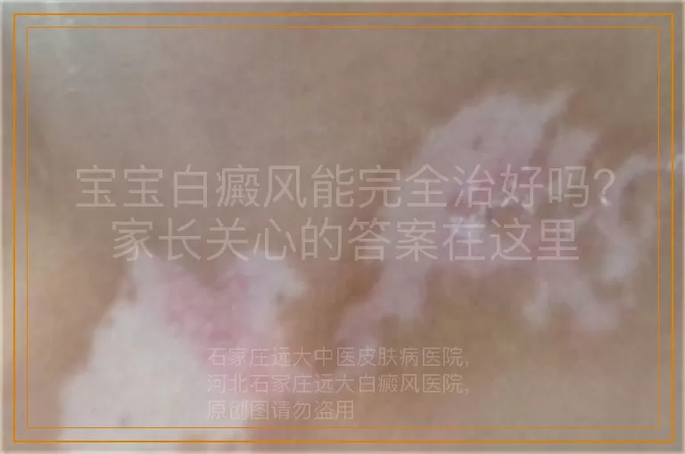 宝宝白癜风能完全治好吗？家长关心的答案在这里