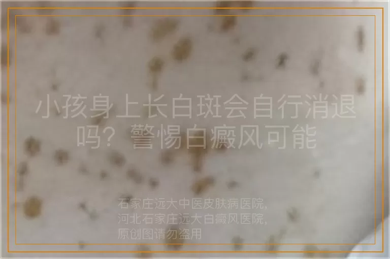 小孩身上长白斑会自行消退吗？警惕白癜风可能