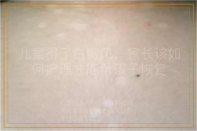 儿童得了白癜风，家长该如何护理才能帮孩子恢复