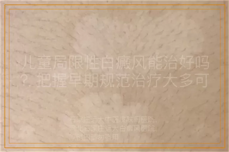 儿童局限性白癜风能治好吗？把握早期规范治疗大多可复色