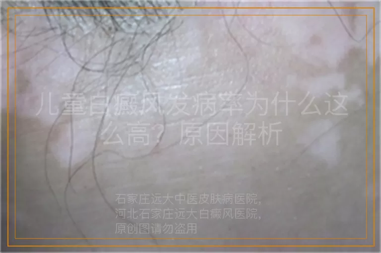 儿童白癜风发病率为什么这么高？原因解析
