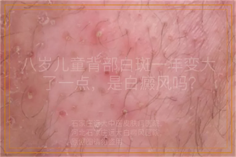 八岁儿童背部白斑一年变大了一点，是白癜风吗？