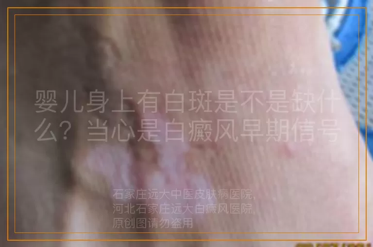婴儿身上有白斑是不是缺什么？当心是白癜风早期信号