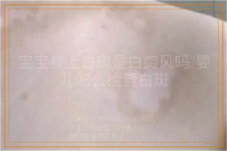 宝宝身上白斑是白癜风吗 婴儿怎么检查白斑