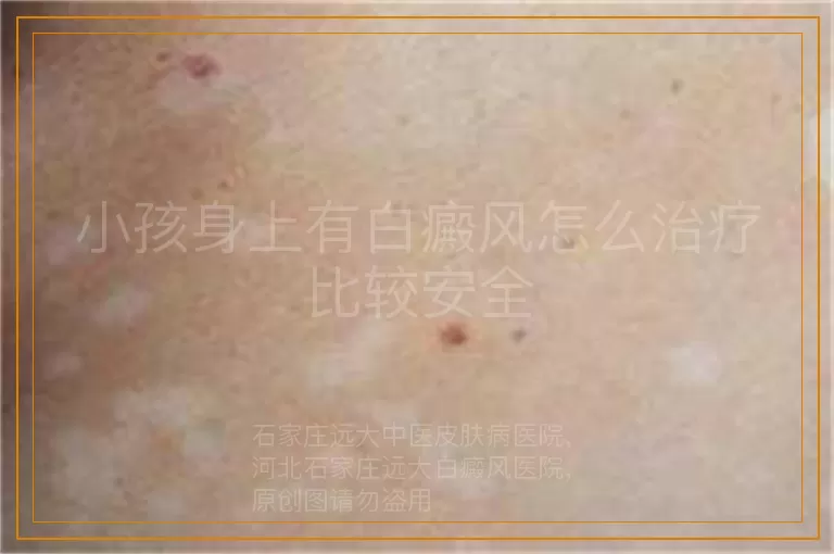 小孩身上有白癜风怎么治疗比较安全