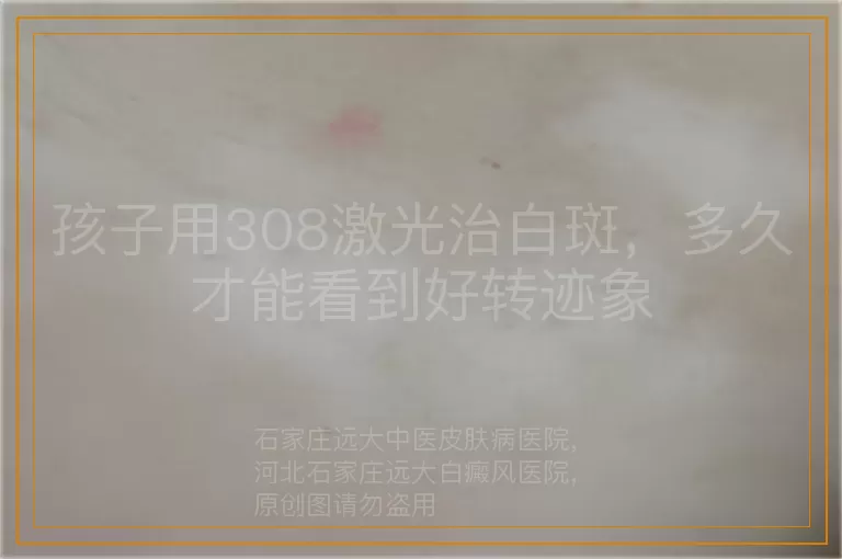 孩子用308激光治白斑，多久才能看到好转迹象