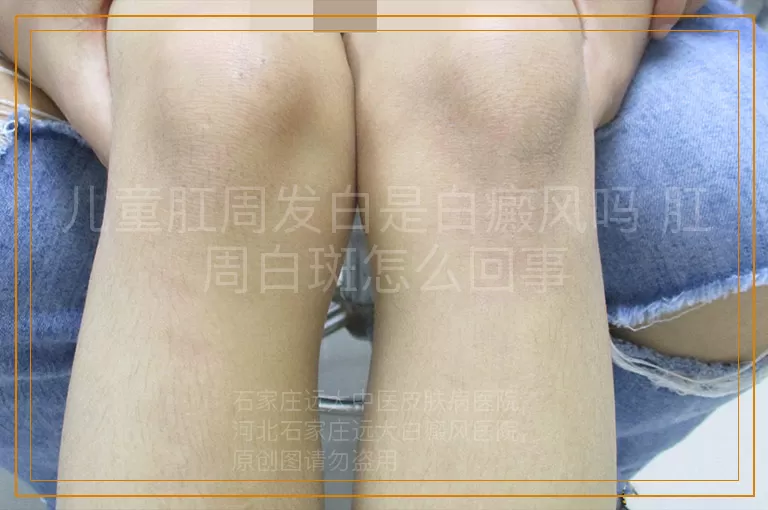 儿童肛周发白是白癜风吗 肛周白斑怎么回事