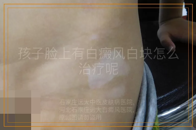 孩子脸上有白癜风白块怎么治疗呢