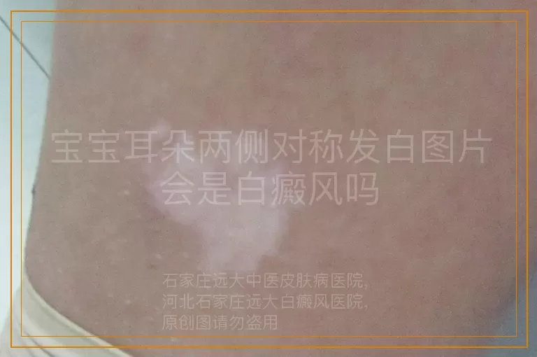 宝宝耳朵两侧对称发白图片会是白癜风吗