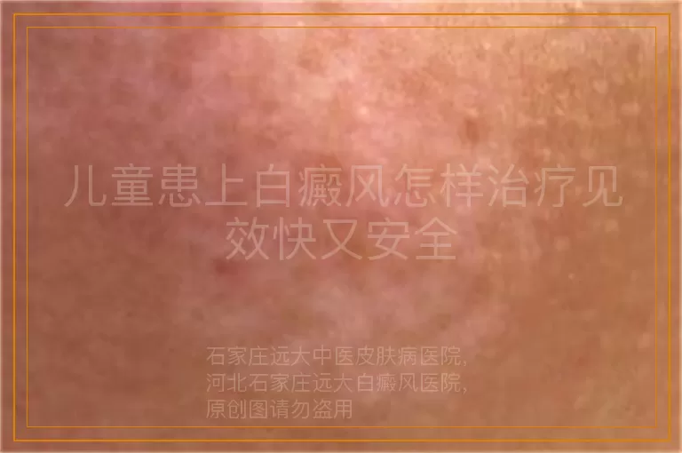 儿童患上白癜风怎样治疗见效快又安全