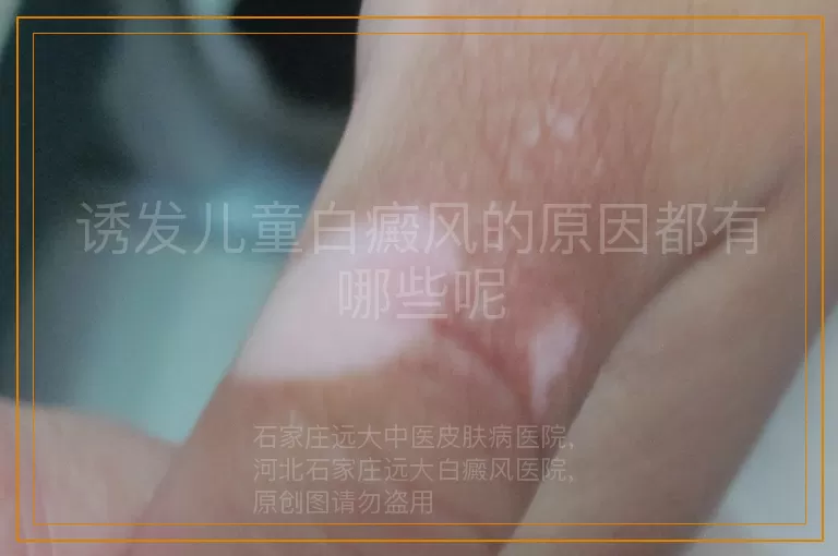 诱发儿童白癜风的原因都有哪些呢