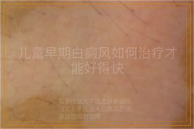 儿童早期白癜风如何治疗才能好得快