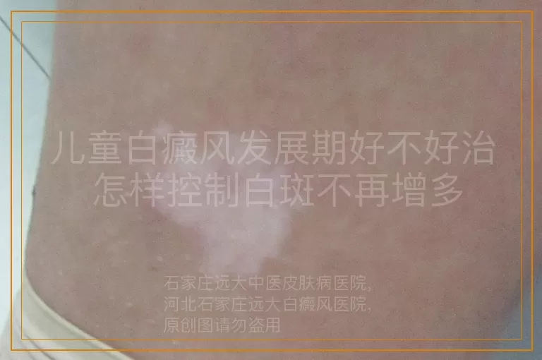 儿童白癜风发展期好不好治 怎样控制白斑不再增多