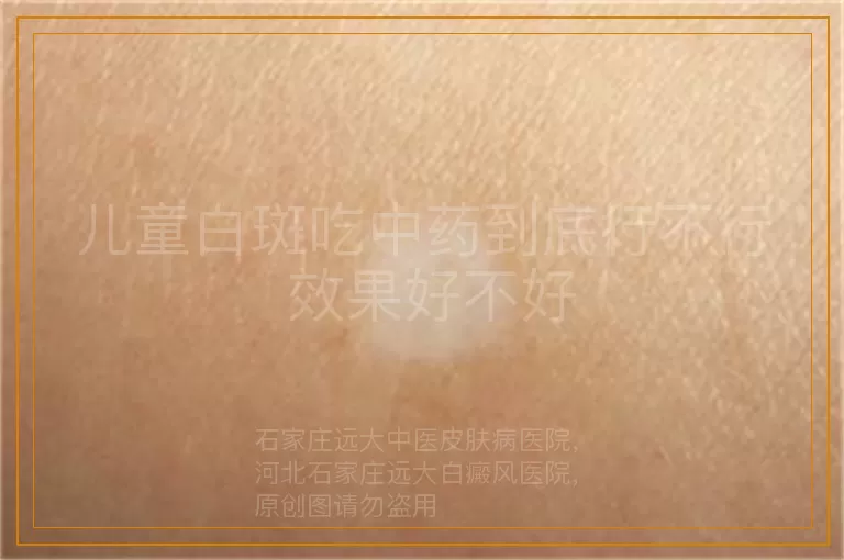 儿童白斑吃中药到底行不行 效果好不好