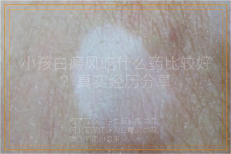 小孩白癜风吃什么药比较好？真实经历分享