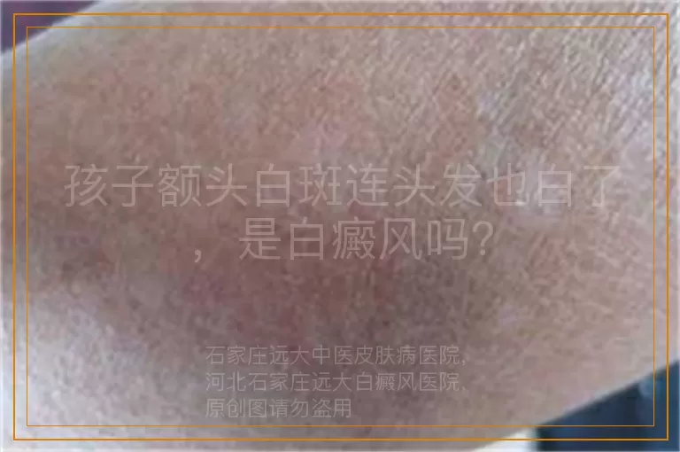孩子额头白斑连头发也白了，是白癜风吗？