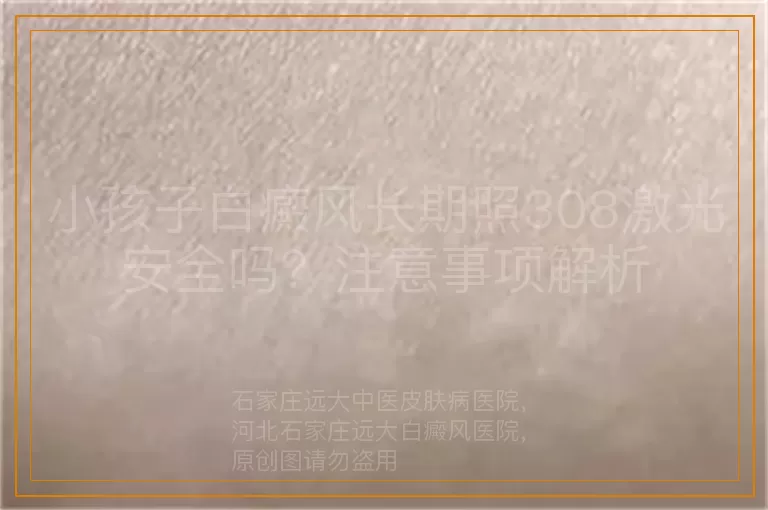 小孩子白癜风长期照308激光安全吗？注意事项解析