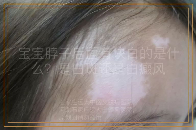 宝宝脖子后面有块白的是什么？是白斑还是白癜风