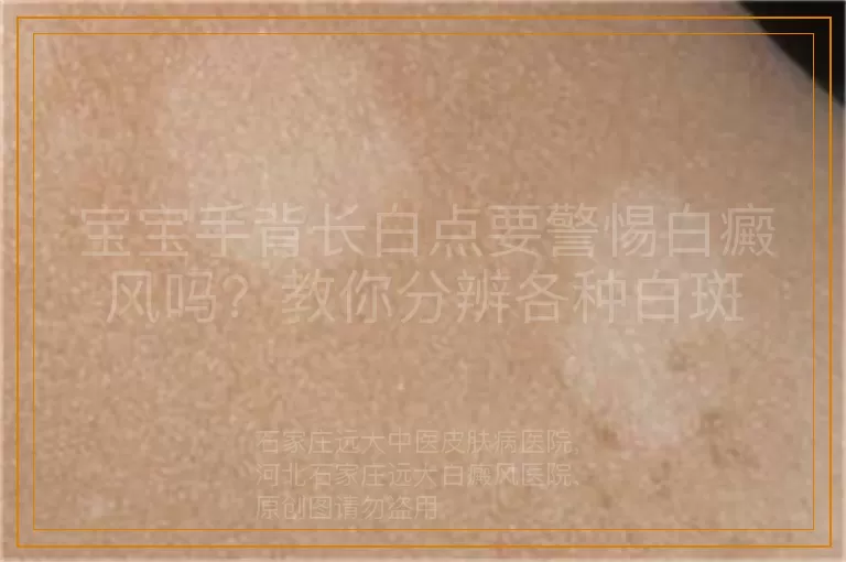 宝宝手背长白点要警惕白癜风吗？教你分辨各种白斑