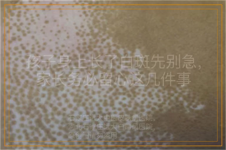孩子身上长了白斑先别急，家长务必留心这几件事
