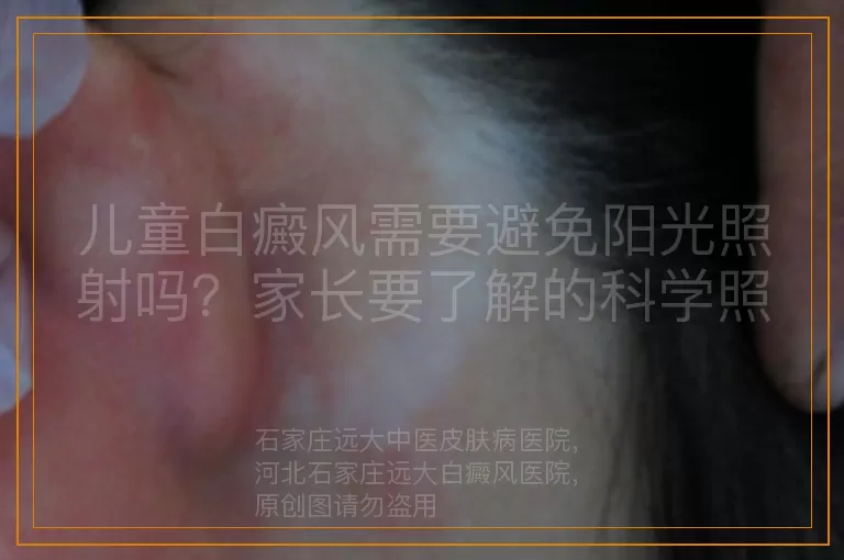 儿童白癜风需要避免阳光照射吗？家长要了解的科学照护法