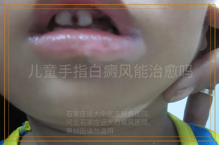 儿童手指白癜风能治愈吗